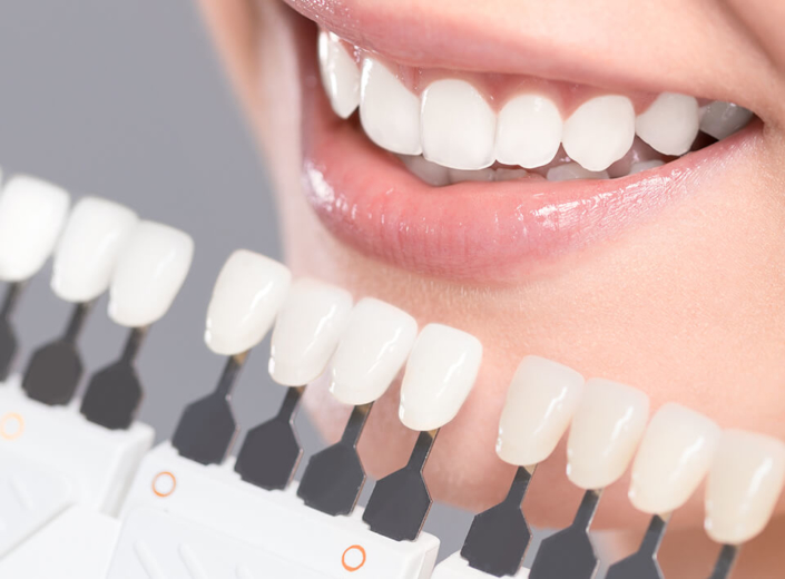 Facette dentaire Belfort Dentisterie esthétique à Belfort